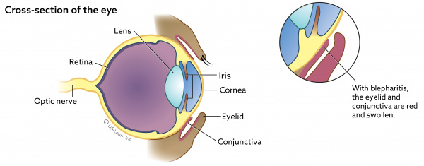 blepharitis